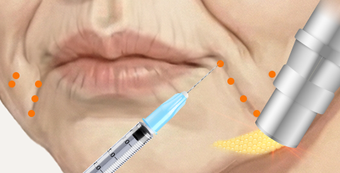 입가주름 리리핏