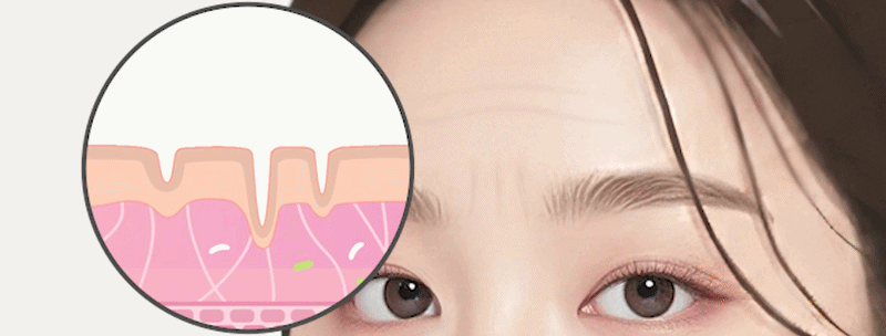 이마주름 리리핏 원리